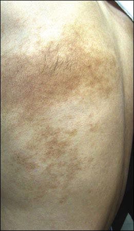 Hairy Hyperpigmented Lesion