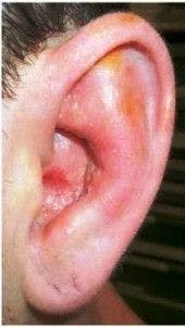 Painful Red Ear