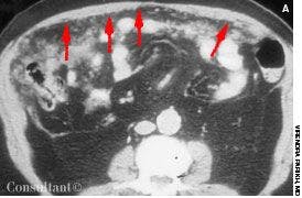 Peritoneal Carcinomatosis