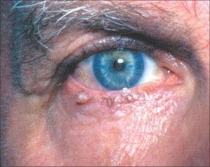 eyelid lesion