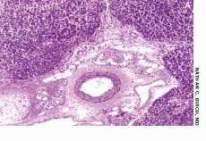 Acute Disseminated Histoplasmosis in a Recovering Alcoholic