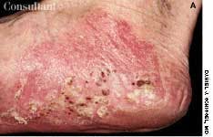 Pustulosis of the Soles