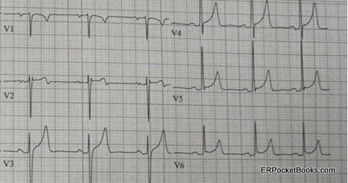 Syncope, Paresthesias, and Weakness in a 35-year-old Man 
