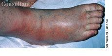 Erythema Nodosum Erythema on Forearms and Legs of a 42-Year-Old Man