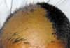 Trichotillomania in a Middle-Aged Man