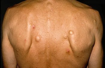 Smooth, Firm Nodules: Your Dx?
