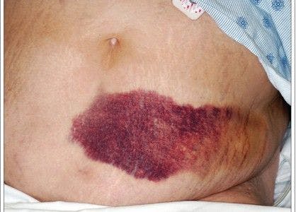 Large Abdominal Ecchymosis: Your Dx?
