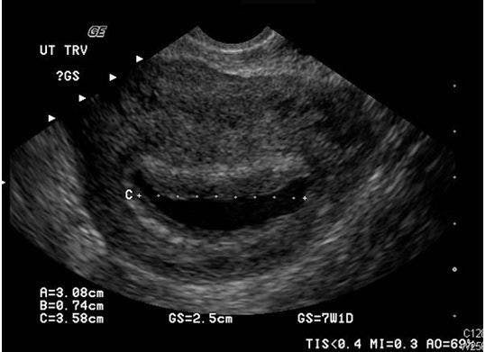 Pseudosac in uterus 