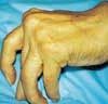 End-Stage Rheumatoid Arthritis