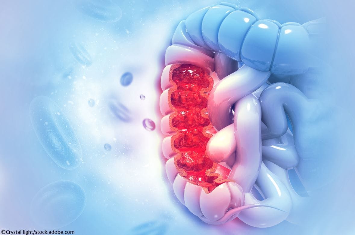 Ustekinumab Demonstrates Sustained Clinical, Corticosteroid-free Remission at 4 Years in Adults with Moderate-to-Severe Ulcerative Colitis 