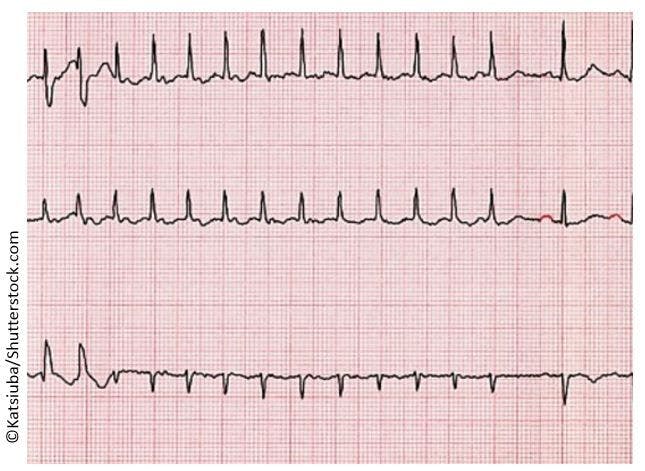 Hypertension, atrial fibrillation, HAS BLED, CHA2DS2-VASC 