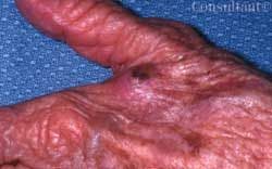 Squamous Cell Carcinoma on the Hand