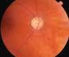 Eye Signs of Systemic Disease: Case 1Hollenhorst Plaques