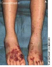 Purpuric Rash After Upper Respiratory Tract Infection