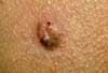 Basal Cell Carcinoma on Arm of a 47-Year-Old Man