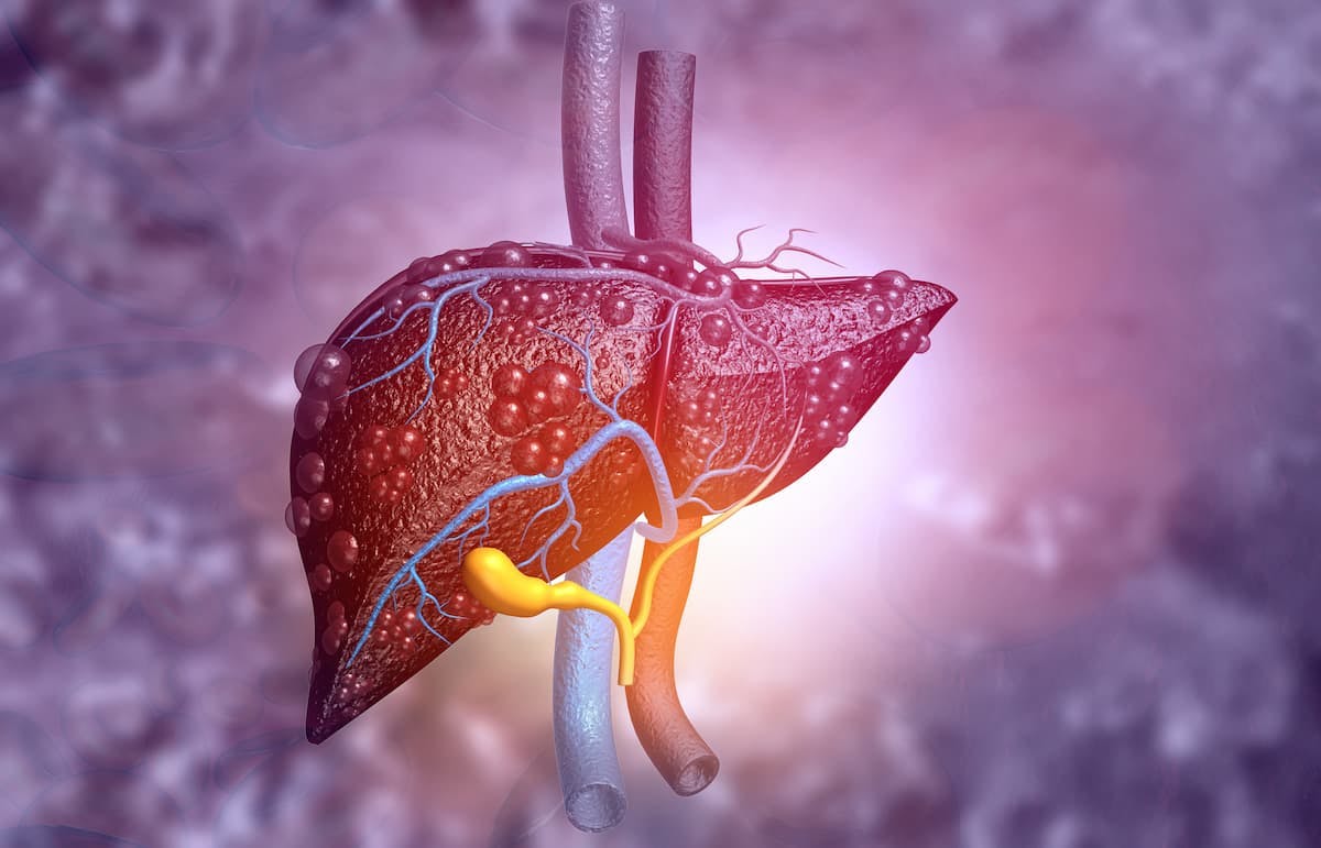 New Data Show Rise in Decompensated Cirrhosis and Hepatic Encephalopathy Cases among US Medicare Beneficiaries / Image credit: ©Rasi/AdobeStock