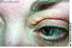 Xanthelasma in a Middle-Aged Man