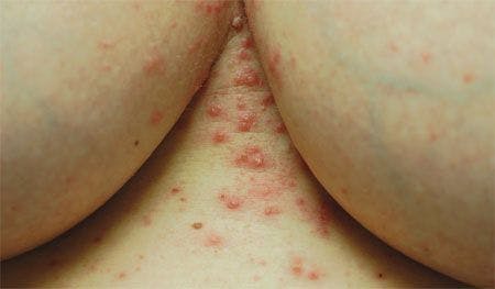 What caused this rash that resists antiviral therapy?