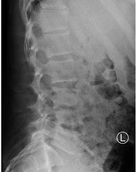 Radiograph, lumbar spine 