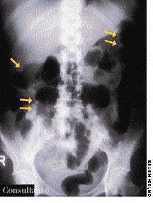 Unusual X-Ray Finding in Pseudomembranous Enterocolitis