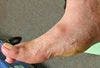 The Charcot Foot: A Missed Diagnosis Can Cost a Limb
