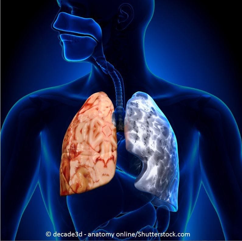 COPD Exacerbations Inflate Lung Function Loss