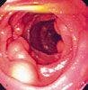 Intestinal Lymphangiectasia