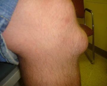 Swelling Over Left Anterior Knee