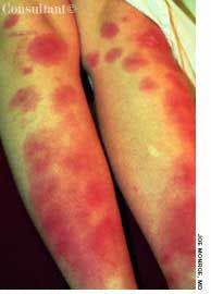 Erythema Nodosum on Thighs and Anterior Tibial Areas of a 36-Year-Old Woman