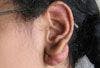 Keloid Associated With Ear Piercing