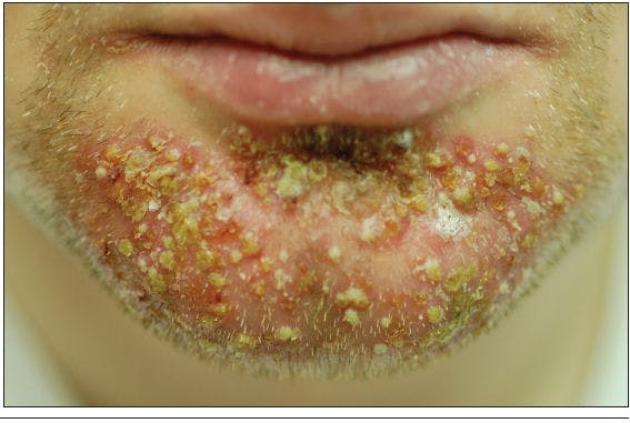 What caused this spreading pustular rash?