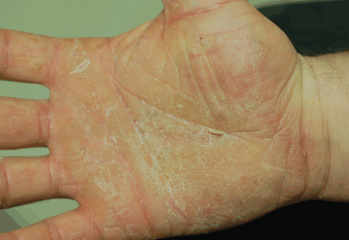 What clue in the photo points to the cause of this chronic hand dermatitis?