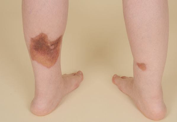 Brown, Dry Plaques: Your Dx?