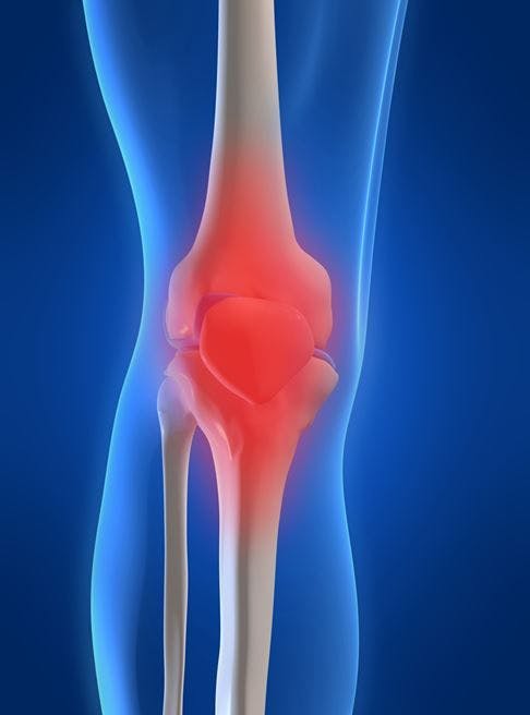 Steroid Shots No Long-Term Help in Knee OA