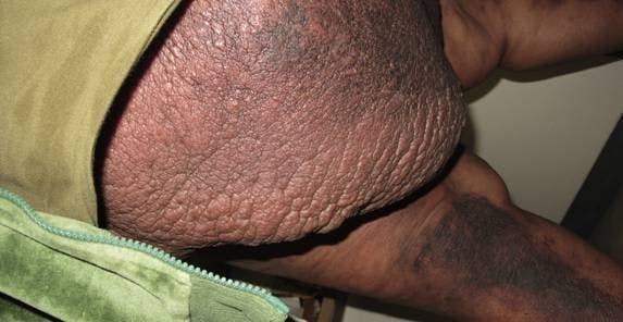 Morbidly Obese Man With Abdominal Wall Cellulitis