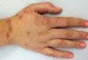 Hyperpigmentation From Bleomycin Injections for Warts