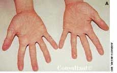Dermatitis on the Hands and Chest