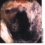 Severe Ischemic Colitis of the Sigmoid Colon