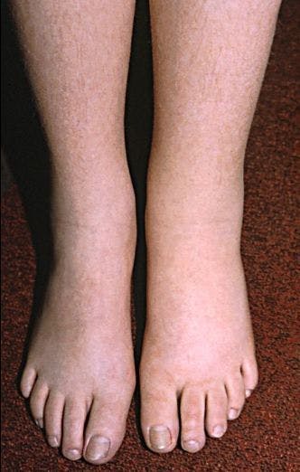 8 Quick Questions About Lymphedema