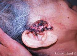 Basal Cell Carcinoma in a 75-Year-Old Woman