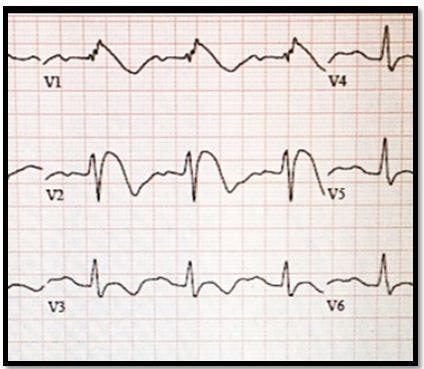 Recurrent Syncope in a 32-year-old Woman: Anxiety? 