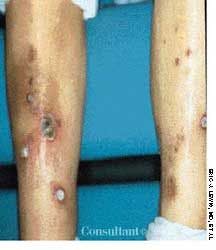 Reactive Perforating Collagenosis