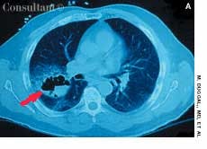 Cavitary Lung Cancer With Metastases
