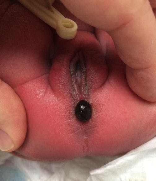Anal Atresia in a Neonate 