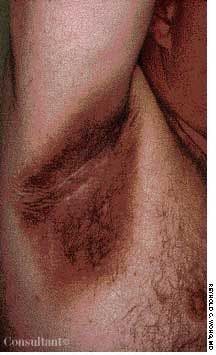 Nicotinic Acid-Induced Acanthosis Nigricans