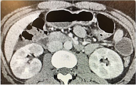 Image: Abdominal CT scan 
