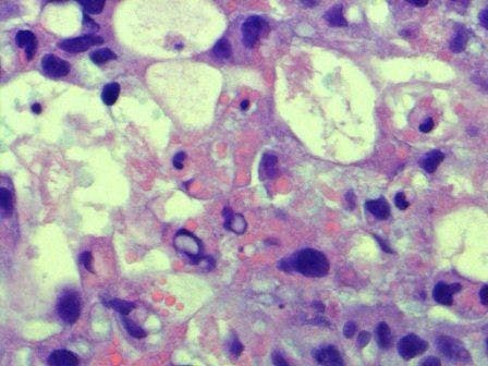 Extra-gonadal germ cell tumors