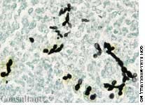 Disseminated Candidiasis in a Man With Alcoholic Cirrhosis
