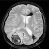 Intracranial Bleeding From Cerebral Amyloid Angiopathy
