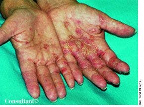 Primary Irritant Cosmetic Dermatitis
